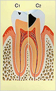 虫歯の進行図1