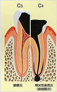 虫歯の進行図2